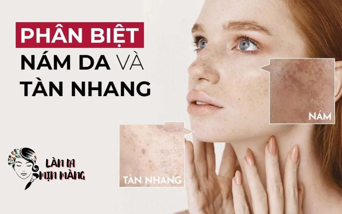 Bí Quyết Phân Biệt Nám Da Và Tàn Nhang Đơn Giản, Chính Xác