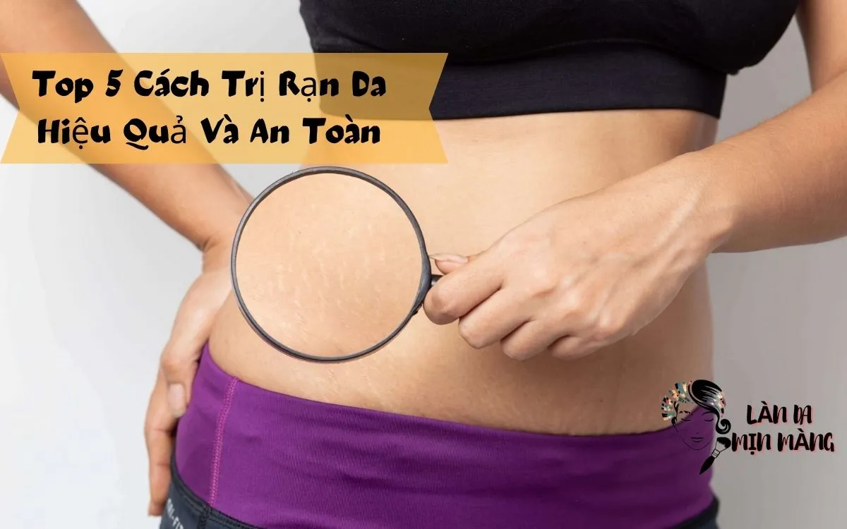 Top 5 Cách Trị Rạn Da Hiệu Quả Và An Toàn