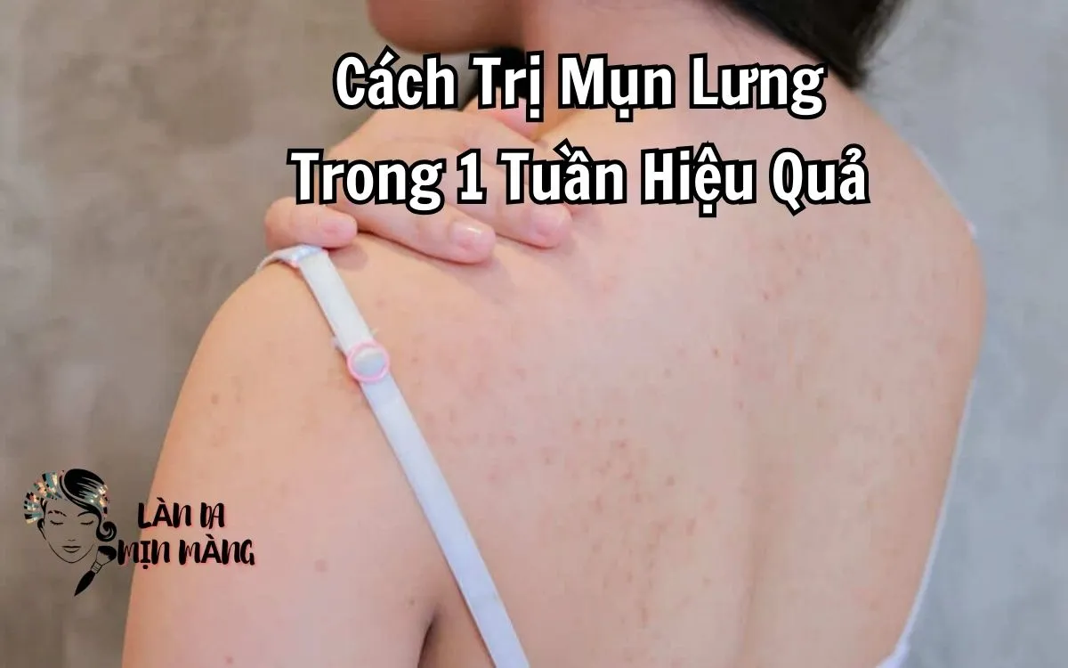 Cách Trị Mụn Lưng Trong 1 Tuần Hiệu Quả